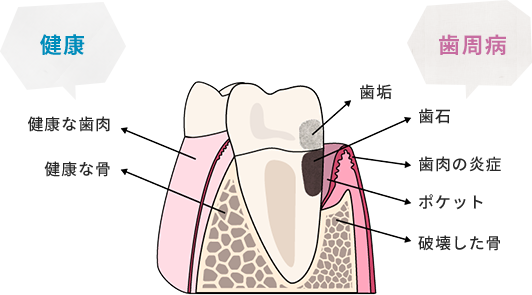  歯の健康な状態と歯周病の状態を表したイラスト。 健康な状態：健康な歯肉、健康な骨 歯周病：歯垢、歯石、歯肉の炎症、ポケット、破壊した骨